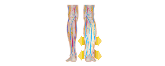 Pycnogenol®’s Natural Defense for Leg Swellings and Venous Disorders